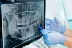 ¿Son seguras las radiografías dentales? Todo lo que necesitas saber